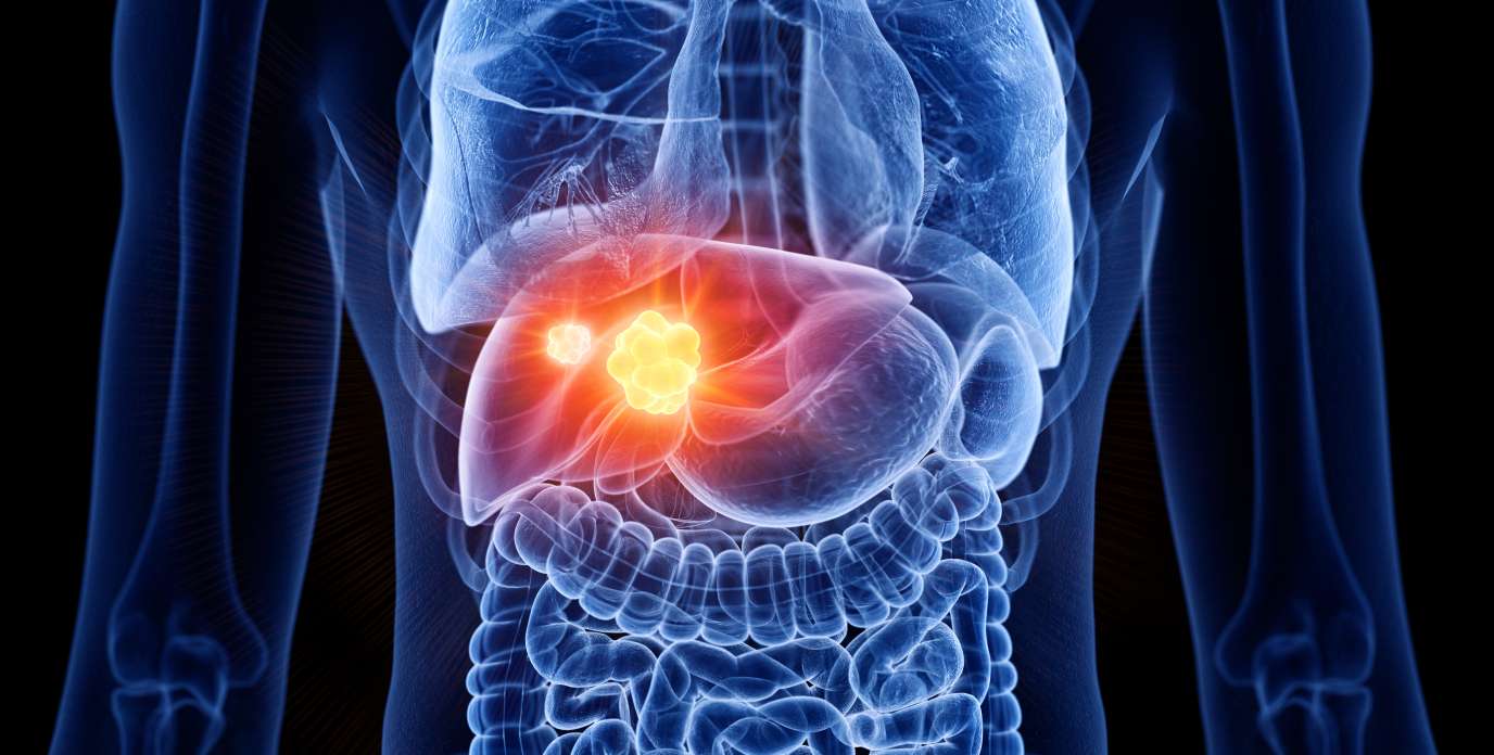 Levels Dx Raises New Investment to Advance Clinical Validation of Early-Stage Liver Cancer Test